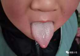 看看你家孩子舌苔是不是這樣的，如果是，那要注意了
